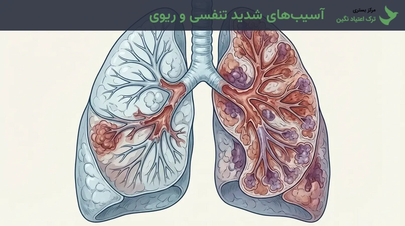 آسیب‌های شدید تنفسی و ریوی