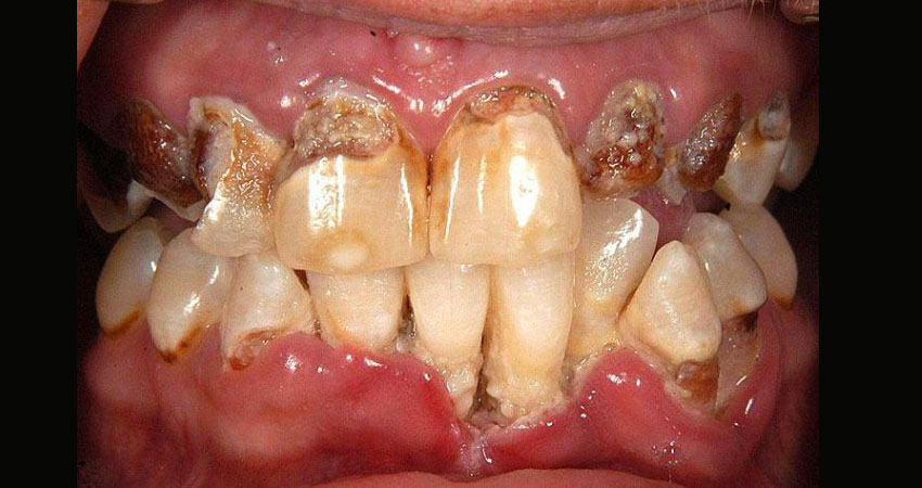 عوارض مصرف شیشه روی دهان که به آن عارضه دهانی مت میگویند عوارض پوستی مصرف شیشه